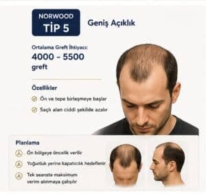 Norwood tipi saç ekimi tip5