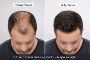 PRP cilt tedavisi öncesi ve sonrası yüz gençleştirme sonuçları