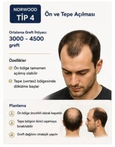 Norwood tipi saç ekimi tip4