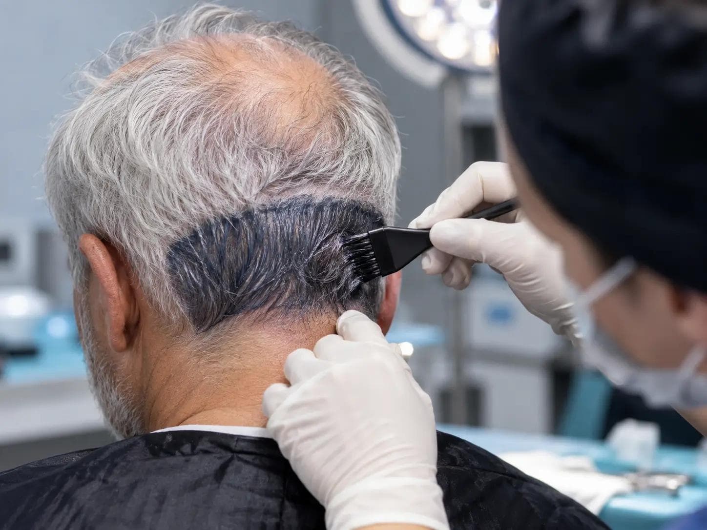 Beyaz saçlarda saç ekimi öncesi donör bölgeye geçici boyama uygulanırken saç ekimine ihtiyaç duyan erkek adayın klinik ortamda arkadan görünümü.